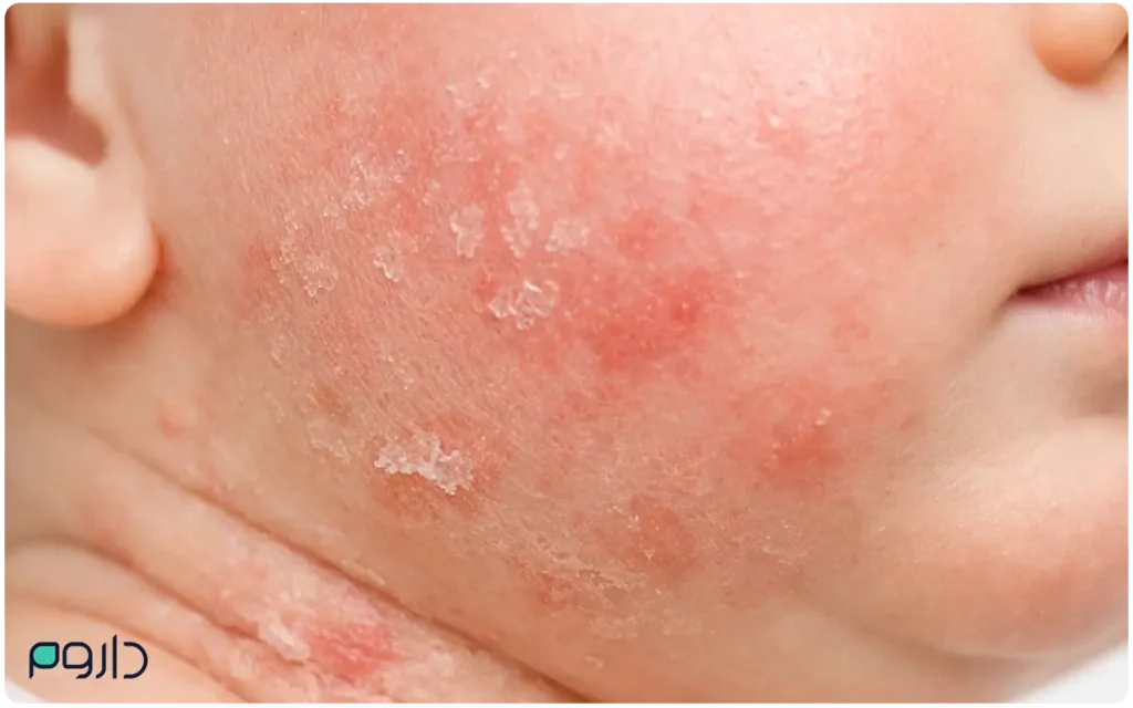 نمای نزدیک از دانه‌های قرمز، اگزما و التهاب روی پوست صورت و گردن نوزاد-داروخانه آنلاین داروم