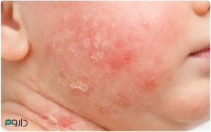 نمای نزدیک از دانه‌های قرمز، اگزما و التهاب روی پوست صورت و گردن نوزاد-داروخانه آنلاین داروم