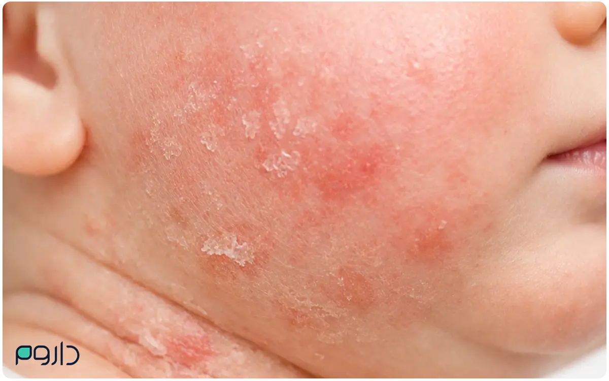 نمای نزدیک از دانه‌های قرمز، اگزما و التهاب روی پوست صورت و گردن نوزاد-داروخانه آنلاین داروم
