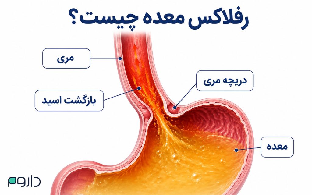 فردی با دست روی معده، نمادی از سوزش معده و رفلاکس