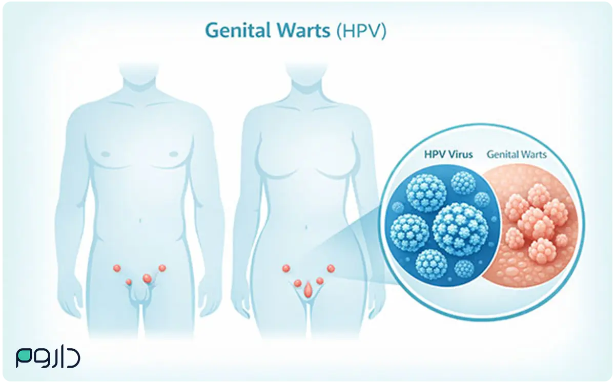 زگیل تناسلی HPV در بدن مرد و زن با نمایش محل ضایعات و مقایسه ویروس و زگیل.