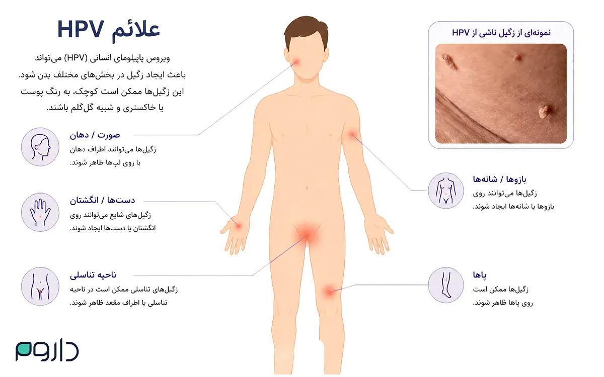 علائم HPV و نواحی شایع بروز زگیل روی بدن، از صورت تا ناحیه تناسلی.