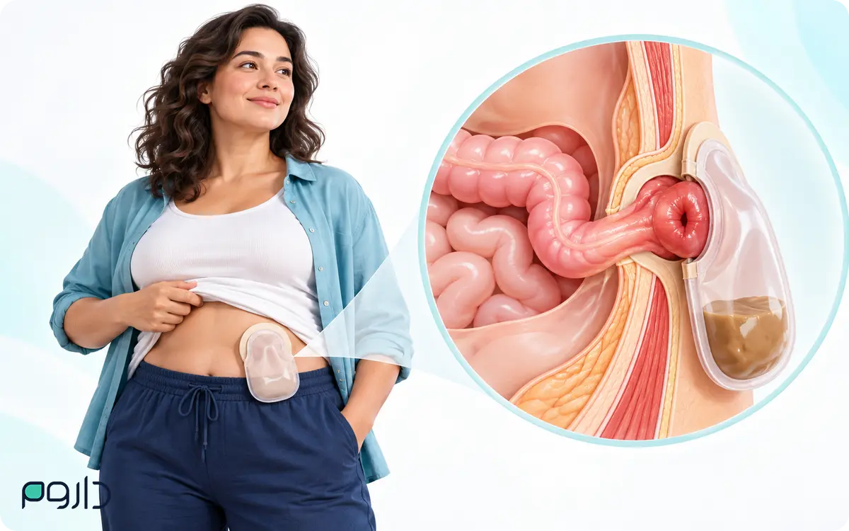 استومی چیست و چه تغییری در دفع ادرار یا مدفوع ایجاد می‌کند؟